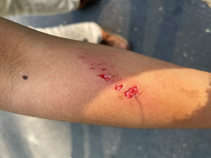 Mordedura de perro